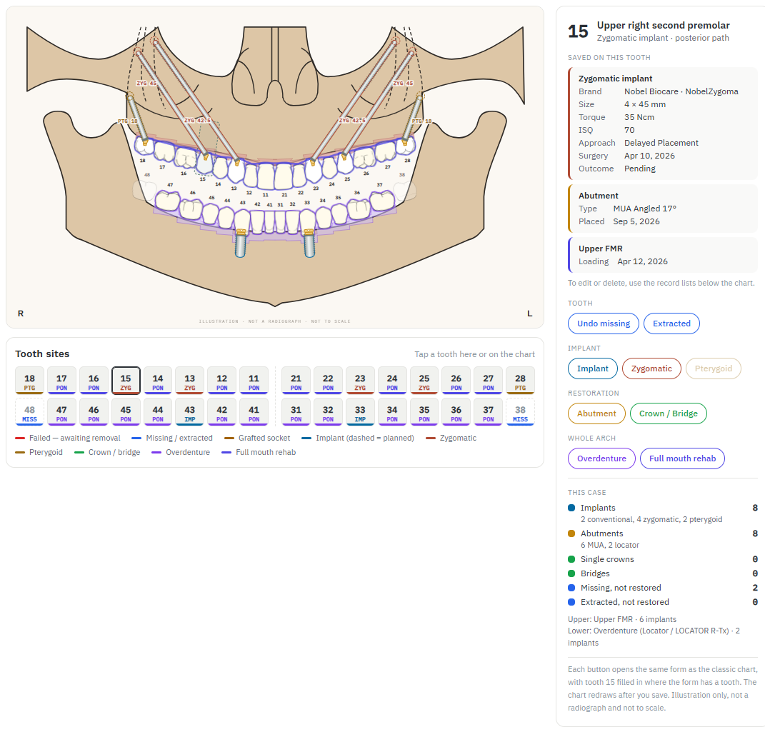 Full-arch sample: four zygomatic and two pterygoid implants under an upper full mouth rehab, with a lower overdenture on two locator implants